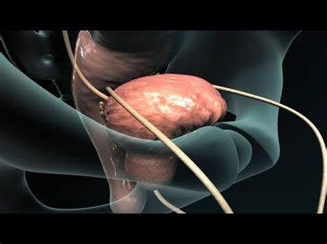 Transurethral Resection Of The Prostate Turp Youtube