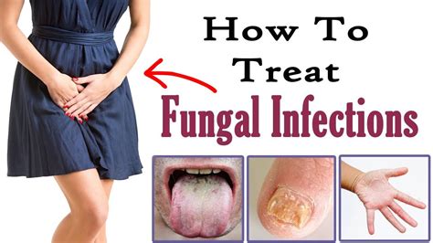 How To Treat Fungal Infection Naturally Home Remedies For Fungal