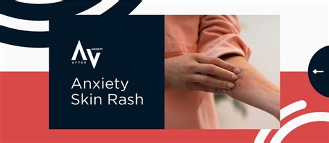 Anxiety Skin Rash How To Get Rid Of Anxiety Rash