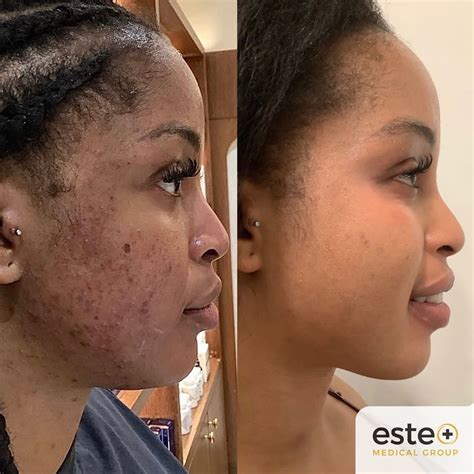 Shocking Pigmentation Removal Results Este