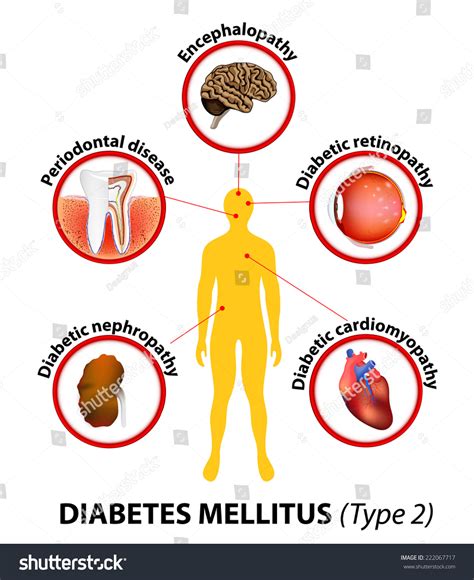 Diabetes Mellitus Type 2 Long Term Complications Include Heart Disease