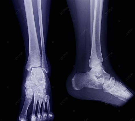 Ankle Xray For Tibia And Fibula Fracture Diagnosis Photo Background And