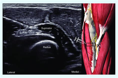 Ultrasound Guided Nerve Hydrodissection Form Health Form Health My