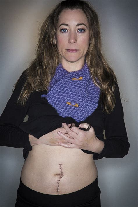 The discovery is made when the cyst gets big enough to cause symptoms, namely abdominal discomfort, and a woman thus undergoes a diagnostic ultrasound. Ovarian Cancer — Cancer GradCAN·cer Blog