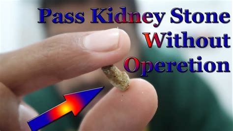 20mm Kidney Stone Treatment Without Operation Home Remedy Youtube