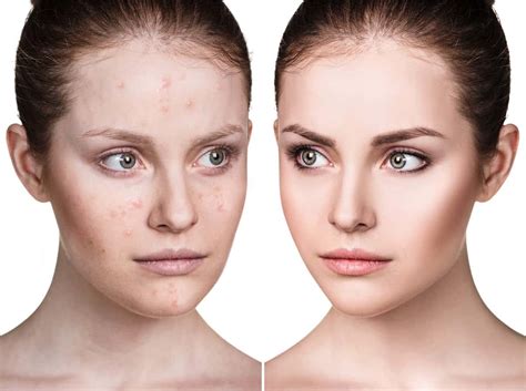 Hormonal Acne Causes And Treatment Harley Street Dermatology Clinic