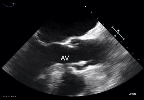 First Transesophageal Echocardiography Long Axis View Showing Aortic