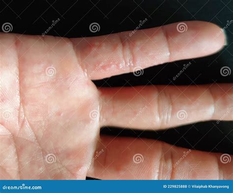 Dyshidrotic Eczema Is An Allergic Skin Condition Stock Photo Image