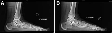 Endoscopically Assisted Reconstruction Of Posterior Tibial Tendon For