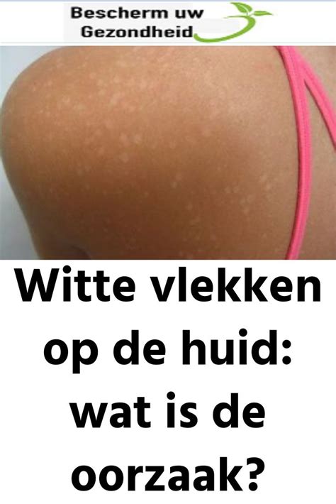 Witte Vlekken Op De Huid Wat Is De Oorzaak Body Teeth Face