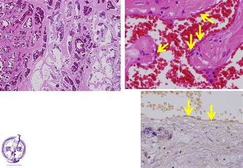 10liver 14 Hepatic Hemangiomapathology Core Pictures