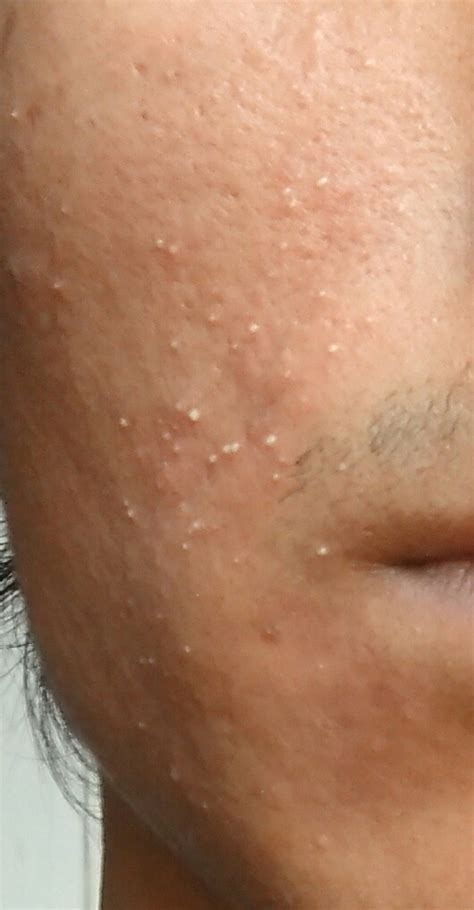 White Type Pimples On Face Even After Cleansing And Exfoliating