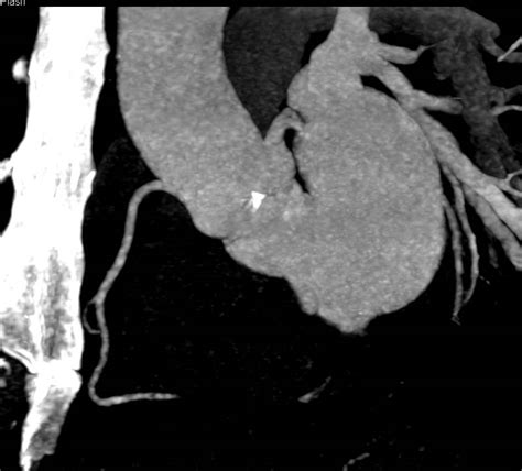 Calcified Aortic Valve With Dilated Ascending Aorta Cardiac Case