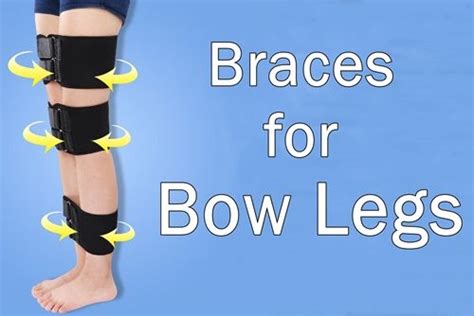 Can Braces Correct Bow Legs Bow Legged Braces Bows