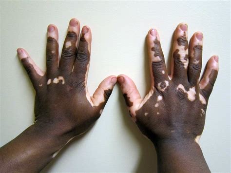 Explainer What Is Vitiligo