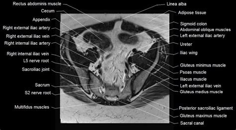 Mri Female Pelvis Anatomy Axial Image Pelvis Anatomy Rectus Abdominis Muscle Pelvis