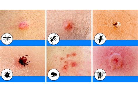 Insect Bites To Look Out For This Summerand How To Treat Them