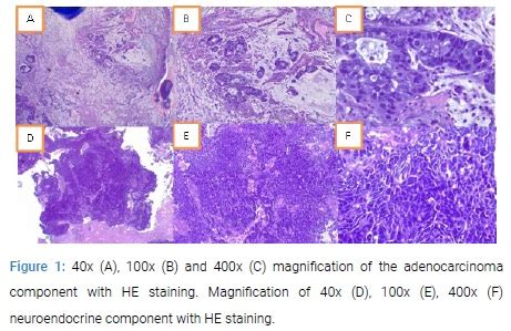 Adenocarcinoma Admixed Neuroendocrine Carcinoma A Rare Case Report Of Years Old Women