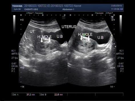 Ultrasound Video Showing Molar Pregnancy Also Called Hydatidiform Mole