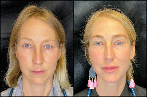 Patient 83697533 Ipl Photofacial With Lumecca Before And After Photos