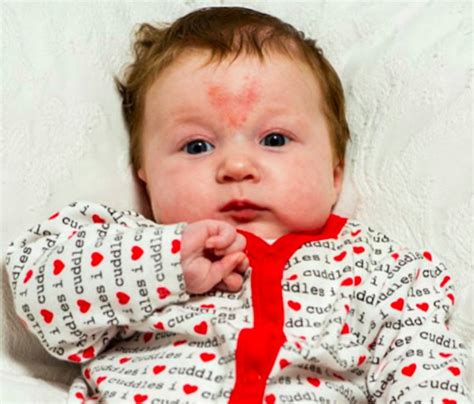 Rare Birthmarks That Will Leave You Stunned Incredibl