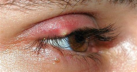 Stye On Your Eyelids Heres Everything You Need To Know Eye Bulletin