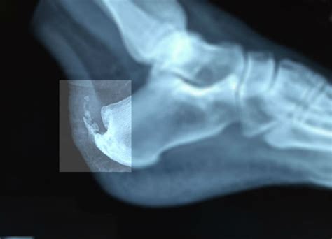 Heel Spur Syndrome Mackay Foot And Ankle