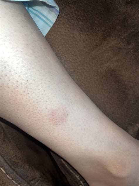 Red Spot On Leg Rmedical