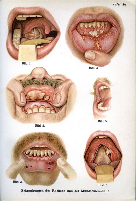 Diseases Of The Throat And Mouth From The Medical Adviser In Words