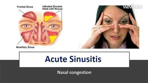 Acute Sinusitis Sinus Infection Or Rhino Sinusitis Youtube