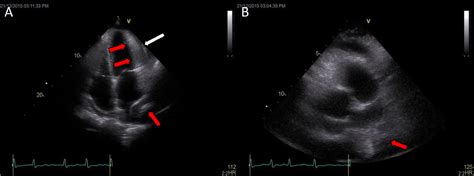Cardiac Tamponade Due To Primary Malignant Pericardial Mesothelioma