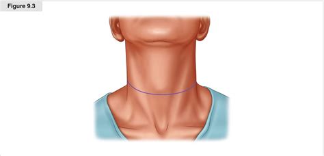 Modified Neck Dissection For Differentiated Thyroid Cancer Oncohema Key