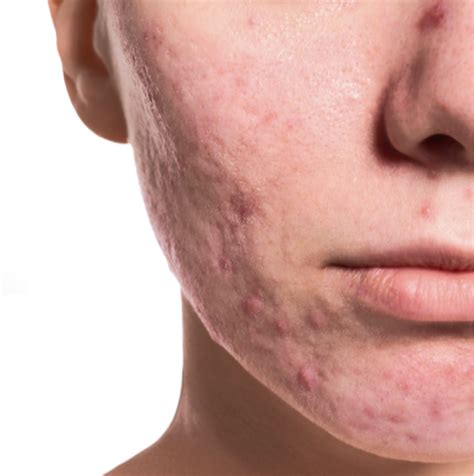 Acne Scar Removal Assurance Skin