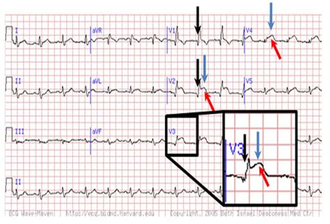 Infarction Septal Wall Infarct