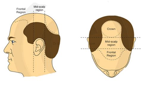 Crown Hair Transplant Growth Time And Timeline Clinicana