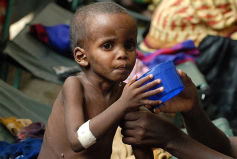 Malnutrition Global Pandemic Affects One Third Of Worlds Population • Health Annotation