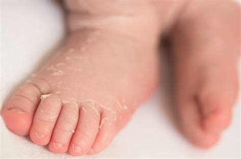 Newborn Skin Peeling Causes And Treatment