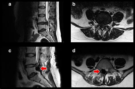 MRI T2 Weight From The Lumbar Spine A And B Show A Massive Lumbar Disc