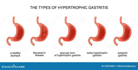 Tipos De Gastrite