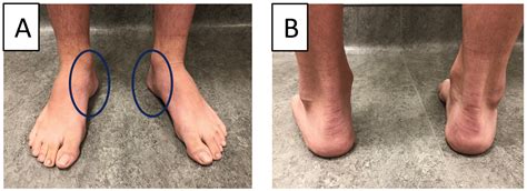Subtle Cavovarus Foot A Missed Risk Factor For Chronic Foot And Ankle