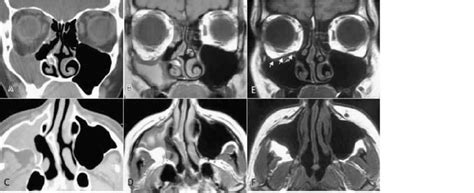Coronal ct reformatted image of trauma slide # 15. Preoperative A) CT in coronal plane shows opacification ...