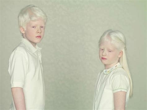 Gustavo Lacerda Albino Human Pale Beauty Albinism