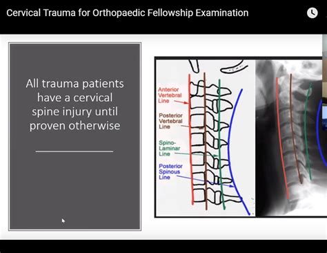 Cervical Spine Trauma For The Frcs Orth —