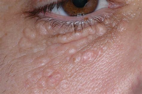 Benign Lesions Of The Eyelid Al Salem Eye Clinic