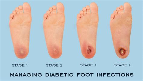 Foot Ulcer Stages Pictures 1 Symptoms And Pictures
