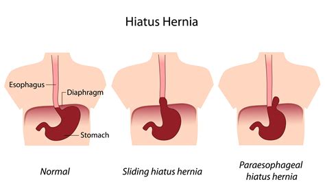 What Is Hiatal Hernia Holistic Blends