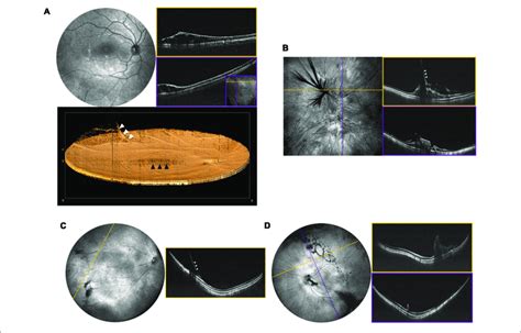 Peripheral Retinal And Vitreoretinal Interface Abnormalities A Oct