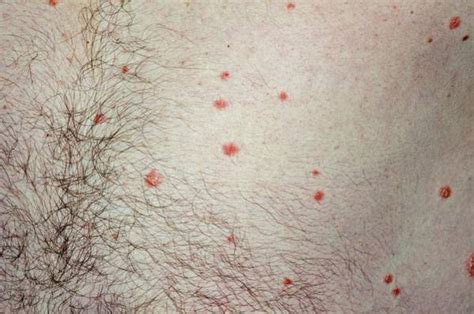 Guttate Psoriasis On The Body Photograph By Dr P Marazzi Science Photo My XXX Hot Girl