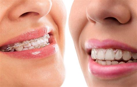 Clear Braces Vs Clear Aligners Advantages And Disadvantages