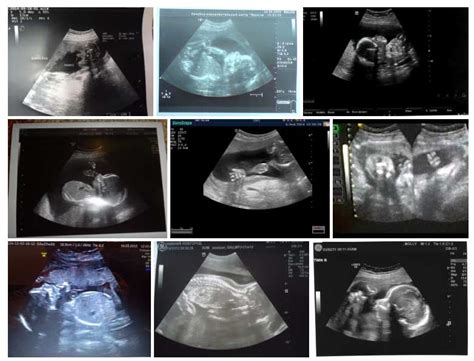 Bebe De Meses De Embarazo Ultrasonido Kumpulan Berbagai Skripsi